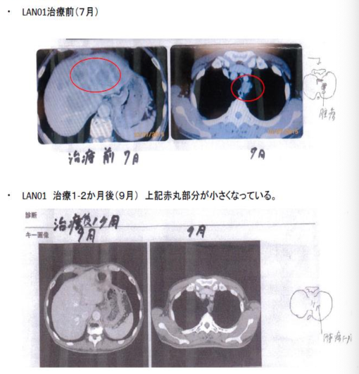 5-FU(TS-1,温熱相乗作用がある)とLAN01併用となった症例の報告の画像所見