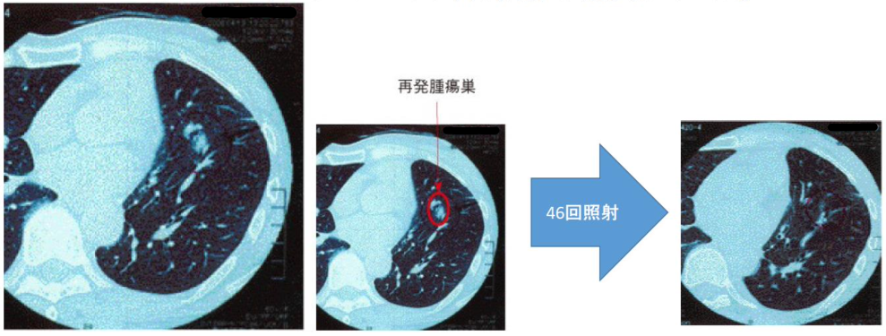 肺癌の画像所見